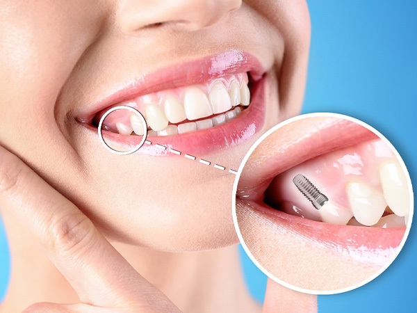 Nose-to-neck ¾ profile view of woman smiling touching jaw with one tooth indicated as an implant