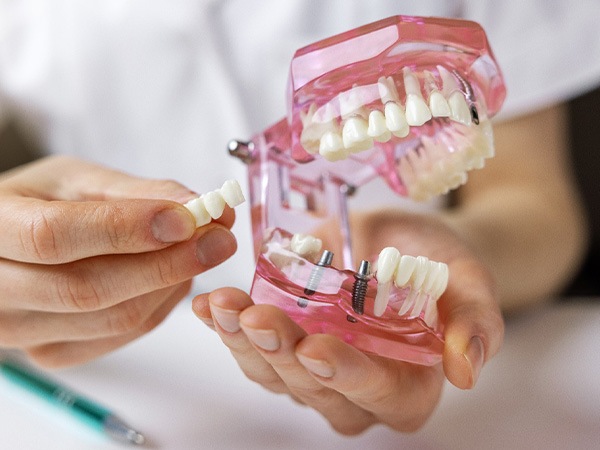 Hands holding model jaw with sample implant bridge