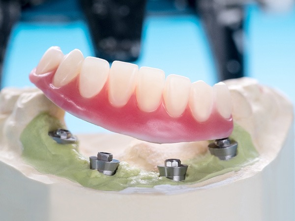 Full set of dentures resting on model jaw with four dental implant posts embedded