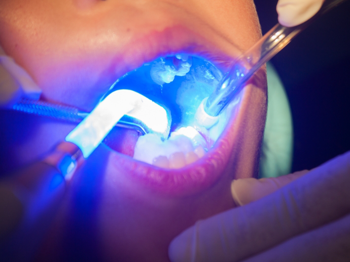 Childrens dentist in Bethlehem placing sealants on a childs teeth