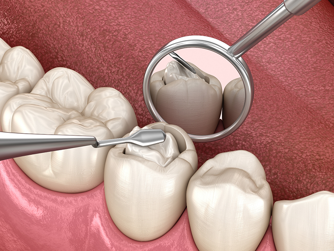 Illustration of dental instruments accessing the innermost layer of a tooth