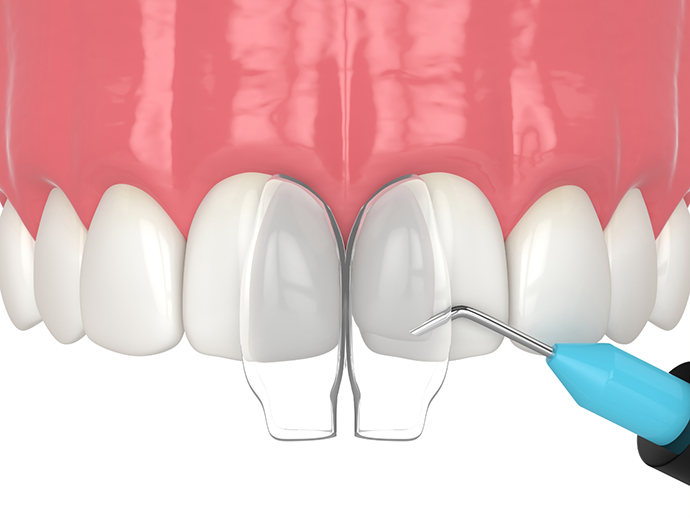 Illustration of dental bonding material being applied to a chipped tooth