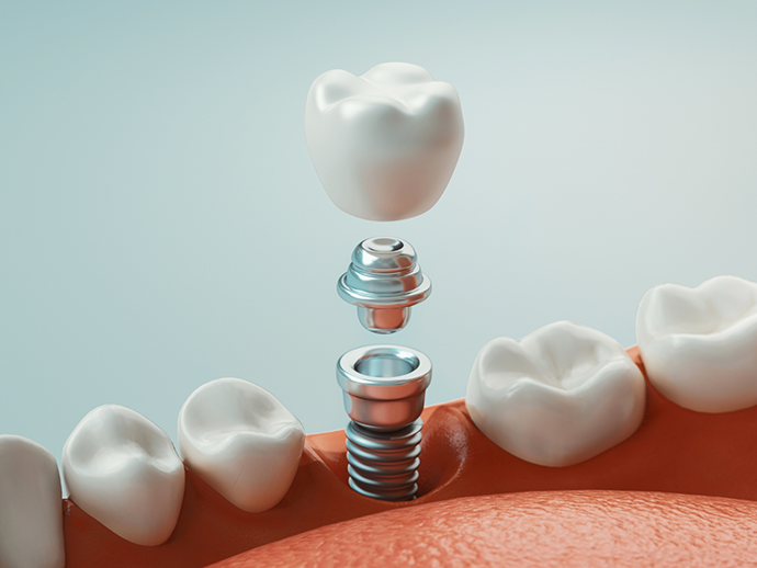 Illustration of a dental implant with a dental crown replacing a missing lower tooth