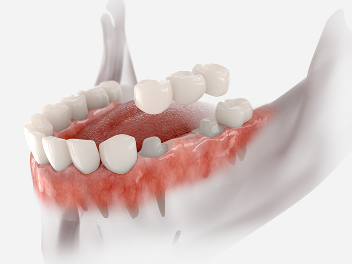 Model of a dental bridge replacing a missing lower tooth