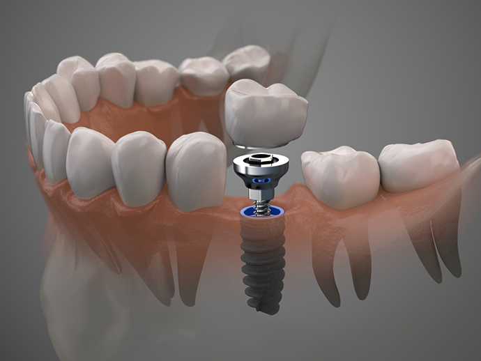 Illustration of a dental implant and dental crown replacing a missing tooth