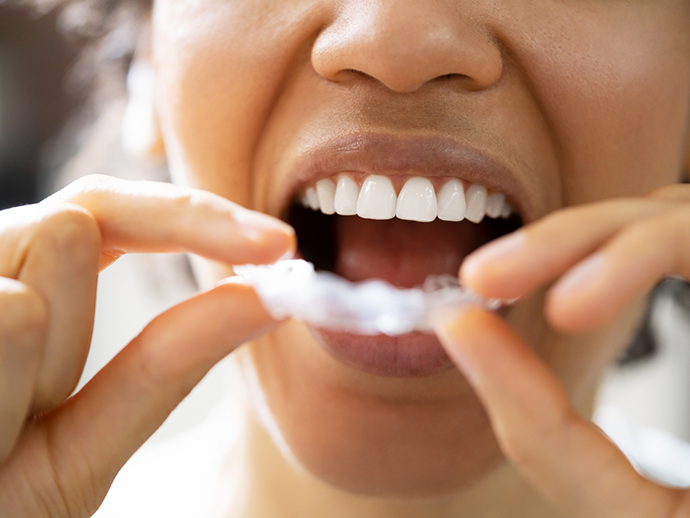 Person placing a white nightguard over their teeth