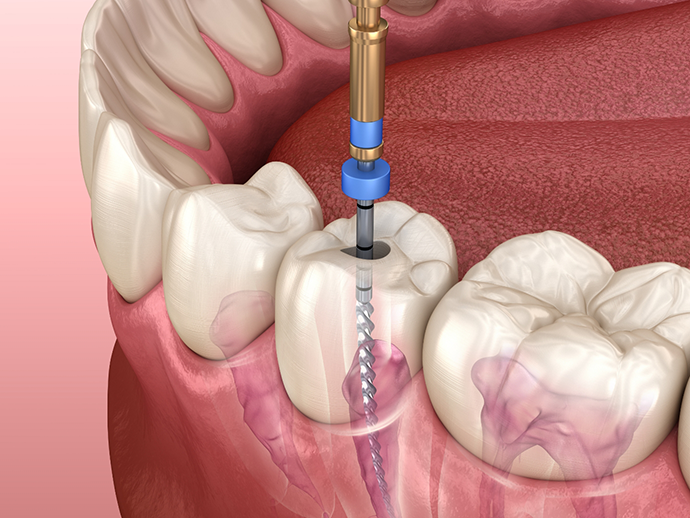 Illustration of a dental instrument treating the center of a tooth